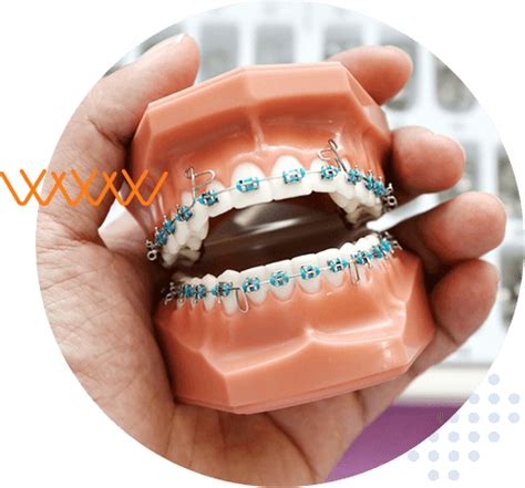 Braces FAQ .